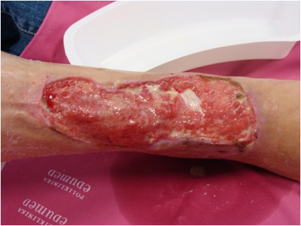 Lower leg ulcers - after SKT reconstruction by Thiersch